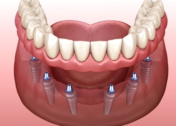 Dentures