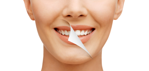 Full Mouth makeover graphic 