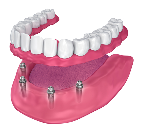 Implant Dentures