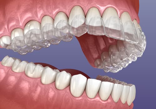 Invisalign