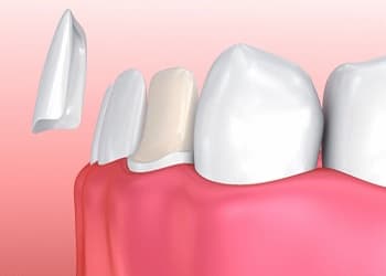 porcelain veneers