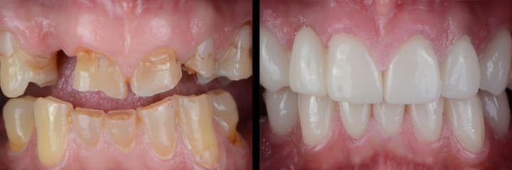 Teeth makeover before and after