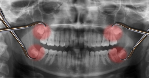 Wisdom teeth graphic