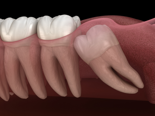 wisdom teeth graphic