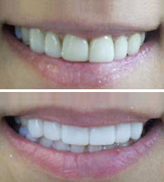 Teeth Whitening Before and After