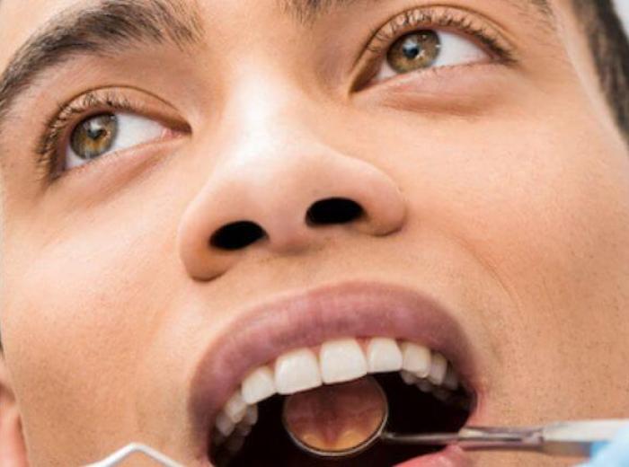 Congenital Aglossia: The Rare Condition of Absence of the Tongue