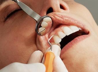 What Happens If Gum Disease Goes Untreated?