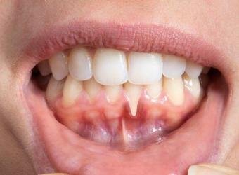 Gum Recession: Causes, Treatment, and Prevention